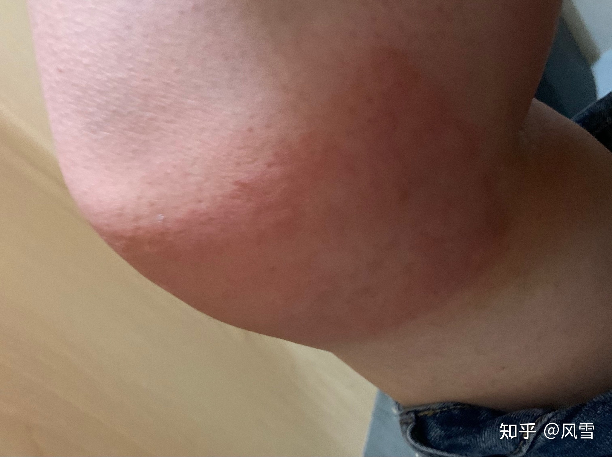 1、貼膏藥過敏癢紅腫怎么辦？